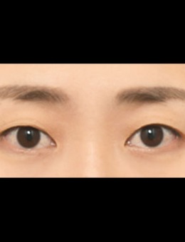 -韩国icon埋线双眼皮手术恢复照片分享