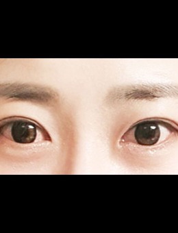 韩国icon埋线双眼皮手术恢复照片分享_术后