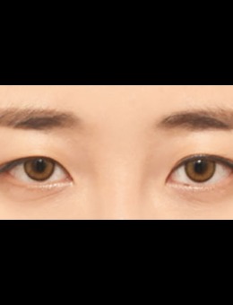 -韩国icon非切开眼肌矫正手术对比照片