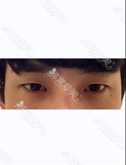 韩国美好MIHO整形男士眼部提肌前后图片