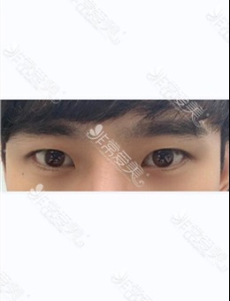 -韩国美好MIHO整形男士眼部提肌前后图片