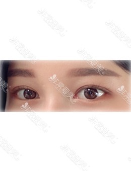 韩国开眼角技术怎么样?我在美好MIHO整形开内眼角+提肌+眼睑下至效果超赞！_术后