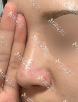 在韩国MIHO整形做驼峰鼻矫正，家人都说好看！_术后