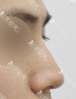 韩国驼峰鼻矫正真人经历：美好MIHO整形做鼻子巨有型！_术前