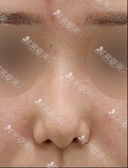 韩国美好MIHO整形医院驼峰鼻中隔手术