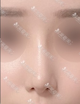 韩国美好MIHO整形医院驼峰鼻中隔手术_术后