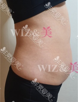 Wiz&美整形外科使用APOLEX技术完成腰腹吸脂例子分享！