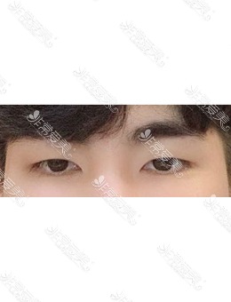 韩国MIHO整形医院男性双眼皮对比，超自然