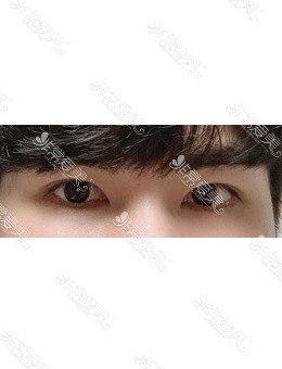 韩国MIHO整形医院男性双眼皮对比，超自然_术后