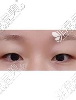 韩国美好MIHO整形医院双眼皮整形照片