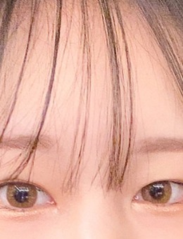 韩国yellow双眼皮切开法+上眼角切开手术对比照_术前