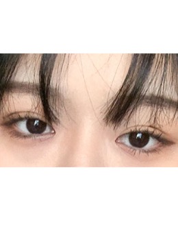 韩国yellow整形自然流畅双眼皮+上眼角手术对比照_术后