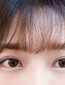 韩国yellow自然流畅型双眼皮真实案例分享_术后