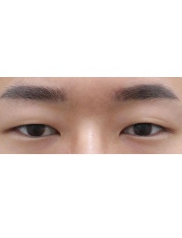 韩国note男士双眼皮整形前后对比照