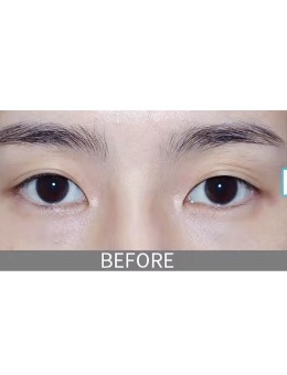 非切割眼角自然流畅双眼皮1个月恢复照