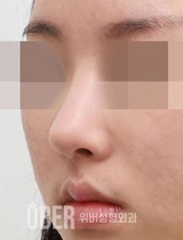 韩国福鼻驼峰长鼻矫正对比照片
