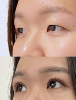 -韩国dr朵“双重黏连埋线法”双眼皮手术对比案例