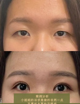 韩国dr朵“双重黏连埋线法”双眼皮手术对比案例_术后