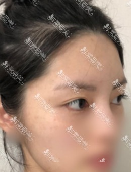 -韩国Dr.朵整形外科眼部脂肪填充前后对比图！