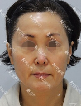 -韩国zell整形smas拉皮+颈部拉皮+面部脂肪再排置对比图！