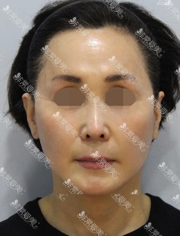 -韩国zell整形smas拉皮+颈部拉皮+面部脂肪再排置对比图！