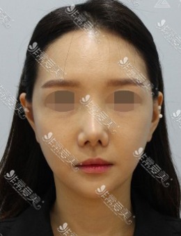 韩国ZELL整形轮廓术后皮肤松弛提升前后对比！