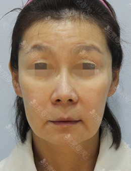 韩国zell整形外科面部smas拉皮+颈部拉皮+面部脂肪再排置对比照片_术前