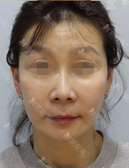 韩国zell整形外科面部smas拉皮+颈部拉皮+面部脂肪再排置对比照片