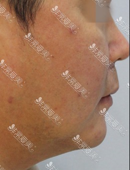 韩国ZELL整形SMAS拉皮手术+面部脂肪重置案例_术前
