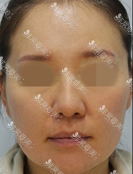 韩国ZELL整形医院额头提升+SMAS拉皮+面部脂肪重置案例_术前