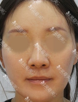 韩国ZELL整形医院额头提升+SMAS拉皮+面部脂肪重置案例_术后