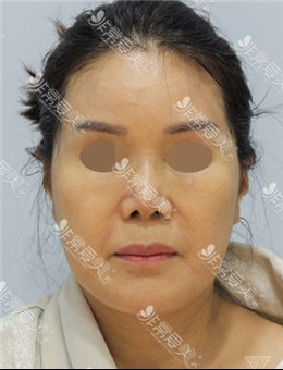 韩国ZELL整形医院拉皮修复术+面部脂肪再排置+鼻修复组图_术前