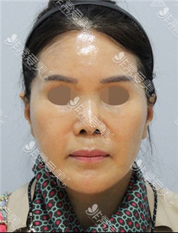 韩国ZELL整形医院拉皮修复术+面部脂肪再排置+鼻修复组图_术后