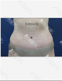 韩国首尔slim外科医院下垂肚皮整形手术对比照_术后