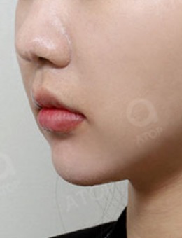 韩国爱她整形面部吸脂手术前后对比照_术后