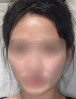 -韩国dr朵凹陷脸填充自体脂肪案例 一掐一水儿胶原蛋白！