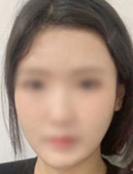 -韩国dr朵凹陷脸填充自体脂肪案例 一掐一水儿胶原蛋白！
