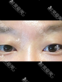 韩国Icon整形非切开眼肌矫正手术对比照
