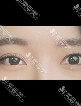 韩国icon整形眼睛一单一双修复双眼皮案例_术前