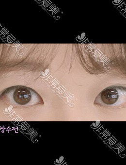 韩国icon三重埋线+去除眼内脂肪对比照片