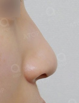 韩国爱她整形隆鼻“小翘鼻尖”手术对比照片_术前