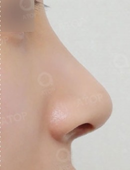 韩国爱她整形隆鼻“小翘鼻尖”手术对比照片_术后