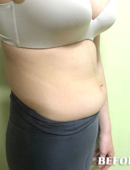 韩国丽迪安整形腰腹吸脂手术1个月对比照