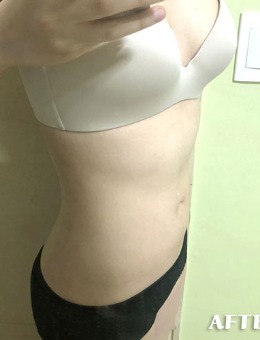 -韩国丽迪安整形腰腹吸脂手术1个月对比照