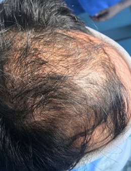 韩国中年男士脱发4500毛发移植经历，三张对比照片看到“枯木逢春”！_术前
