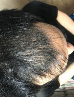 韩国中年男士脱发4500毛发移植经历，三张对比照片看到“枯木逢春”！