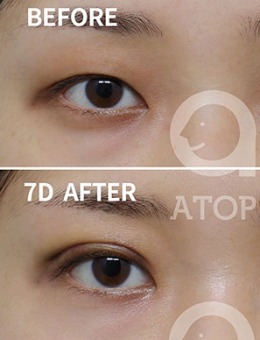韩国爱她整形双眼皮手术3组恢复照片过程分享_术前