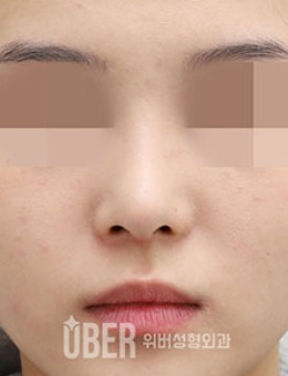 韩国玉芭uber短鼻隆鼻手术对比照