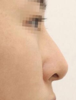 -韩国note整形隆鼻修复3个月恢复照片
