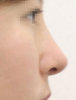 -韩国note整形隆鼻修复3个月恢复照片